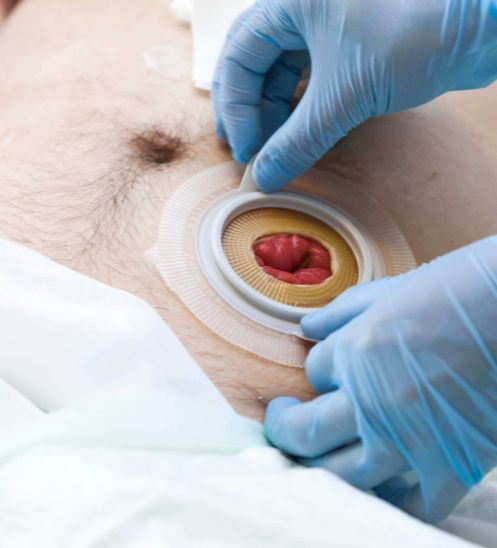 Stoma Care