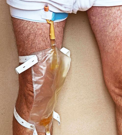 Catheter Care